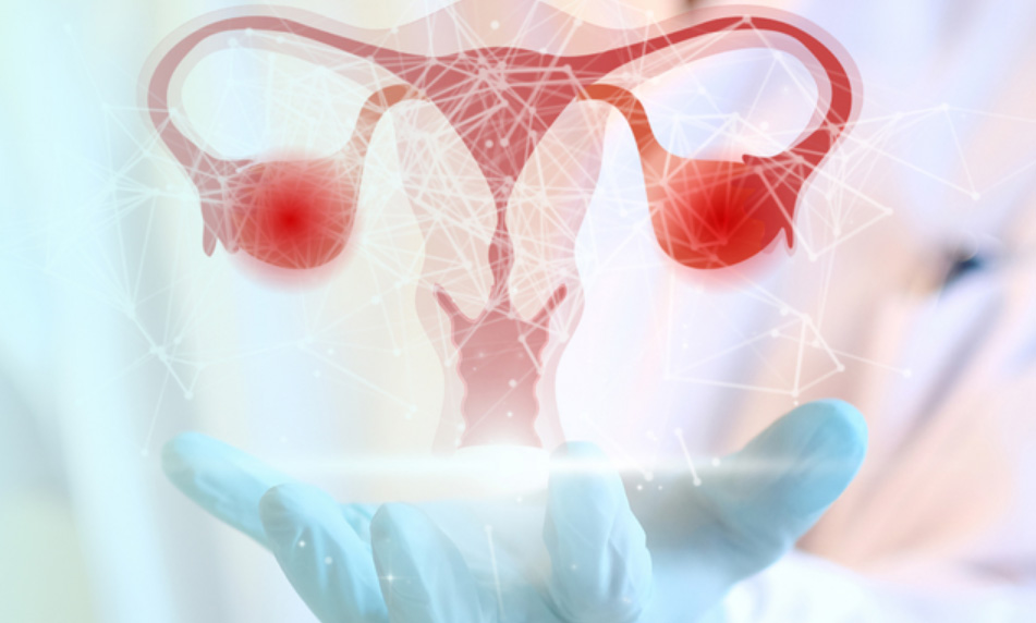 cáncer de ovario cura